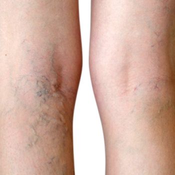 vein-therapy-varicose-vein-treatment-spider-vein-removal-dayton-oh